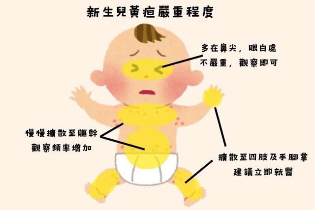 新生兒黃疸嚴重程度